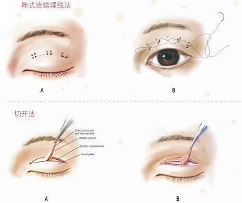 北京雙眼皮手術(shù)課程需要學(xué)什么