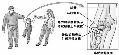 成都小兒推拿教程小兒橈骨頭半脫位